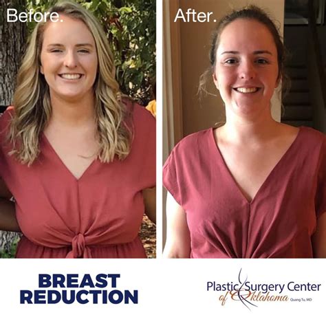 Breast Reduction Before and After Pictures